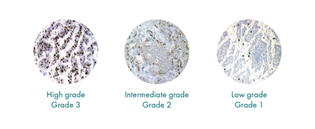 A photo of a high grade (grade 3), intermediate grade (grade 2), and low grade (grade 1) tumour cells.