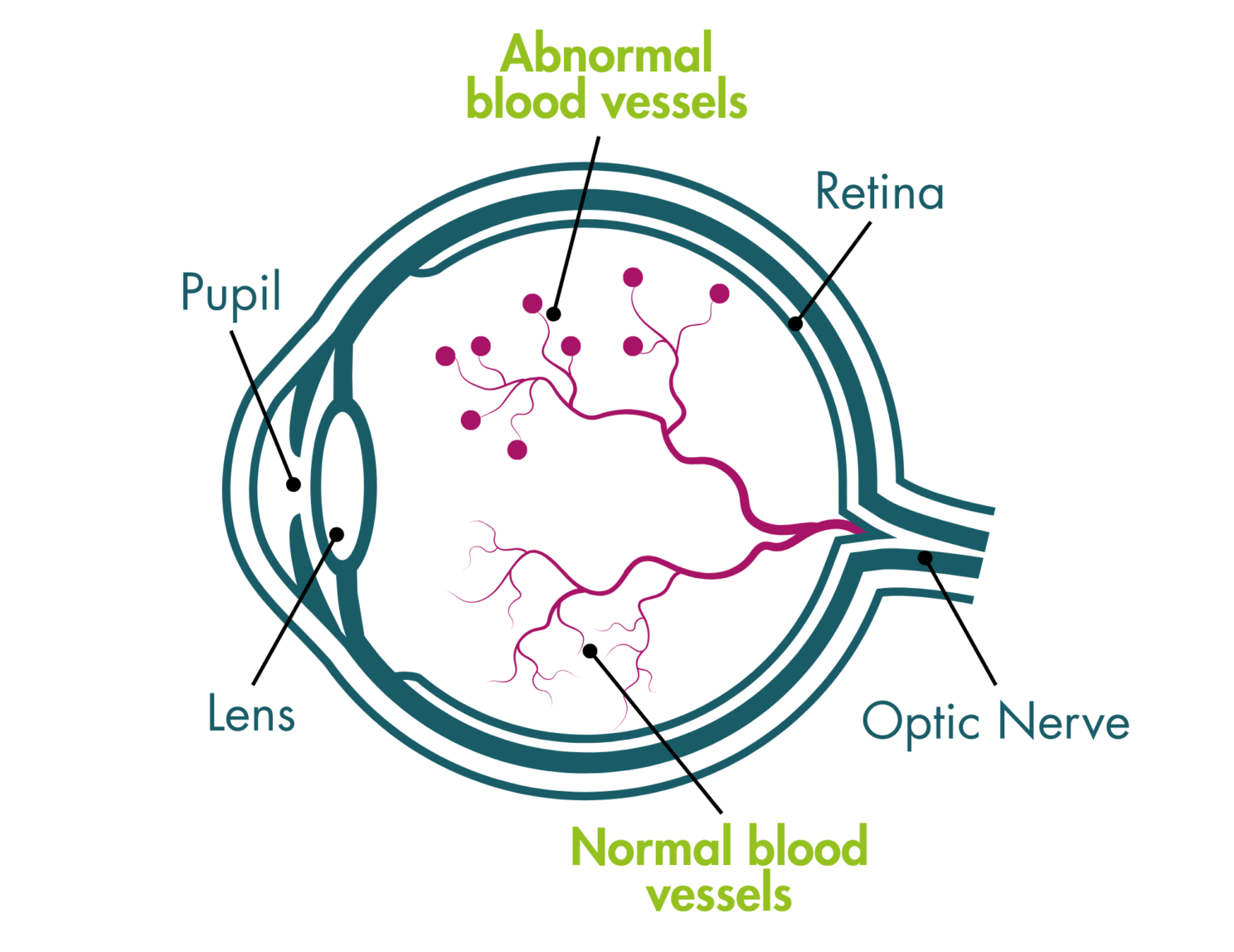 Blood Rop Retinopathy of prematurity (ROP) - ADVANZ PHARMA for Patients