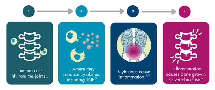 4 boxes labelled 1 to 4 with arrows between them. The first box contains an image of a spine and immune cells with the text “Immune cells infiltrate the joints…”, the second has immune cells and chemicals with the text “where they produce cytokines, including TNF. (reference 3)”, the third has a pelvis with a radiating circle and the text “cytokines cause inflammation.”, and the last has a spine with fused vertebrae, bony projections, and radiating lines with the text “Inflammation causes bone growth so vertebra fuse. (reference 2)