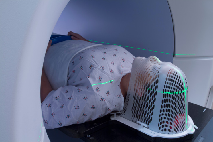 A photo of someone undergoing radiotherapy whilst wearing a radiotherapy mask.