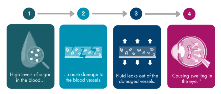 4 boxes labelled 1 to 4 with arrows between them. The first box contains an image of a blood drop with a magnifying glass that shows sugar in the blood and the text “High levels of sugar in the blood…”, the second box shows a broken blood vessel and the text “...cause damage to the blood vessels”, the third box has arrows leaving the blood vessel and the text “fluid leaks out of the damaged vessels”, and the final box contains a cross section of an eye with pressure written inside and the text “causing swelling in the eye (reference 2).”.