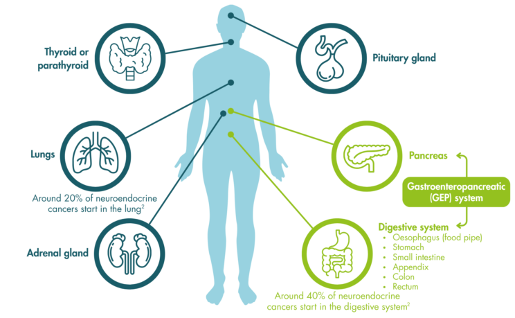 An infographic with a person in the centre with arrows pointing to different body parts that NETS develop in, as follows. Thyroid or parathyroid, Lungs (around 20% of neuroendocrine cancers start in the lung), adrenal gland, and pituitary gland. Two other arrows point to the pancreas and the digestive system (around 40% of neuroendocrine cancers start in the digestive system). Together these two systems form the gastroenteropancreatic (GEP) system. The digestive system includes the oesophagus/food pipe, stomach, small intestine, appendix, colon, and rectum.