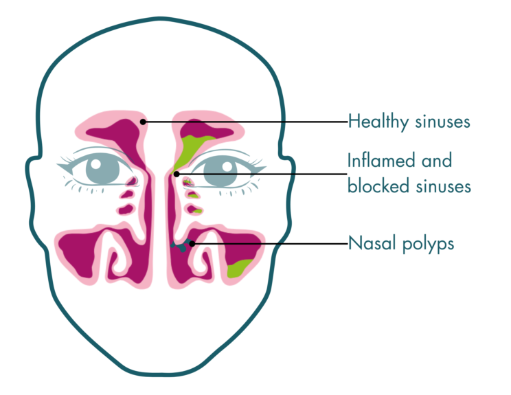 graphic of a face showing the sinuses on the left and right sides of the face. Left sinuses are shown to be healthy with no blockages. The right sinuses are filled with green fluid and are blocked, the passages also appear smaller as they are inflamed. There are also 3 small spherical objects representing nasal polyps in the sinus cavity behind the nose showing how they can cause irritation.