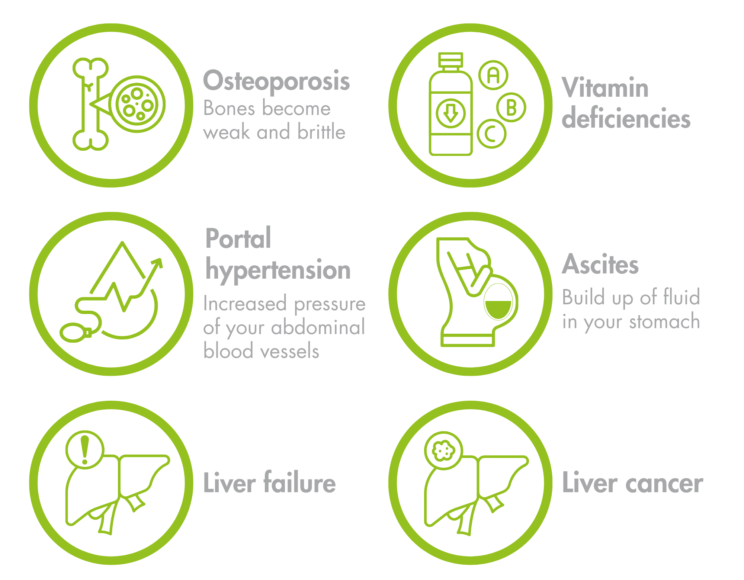 A list of complications from advanced PBC. Osteoporosis (Bones become weak and brittle), vitamin deficiencies, portal hypertension (increased pressure of your abdominal blood vessels, ascites (build up of fluid in your stomach), liver failure, liver cancer.