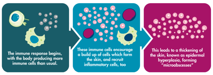 Diagram explaining the immune response in PsA, starting with immune cell buildup, then a buildup of skin cells and recruitment of inflammatory cells, which lead to a thickening of the skin.