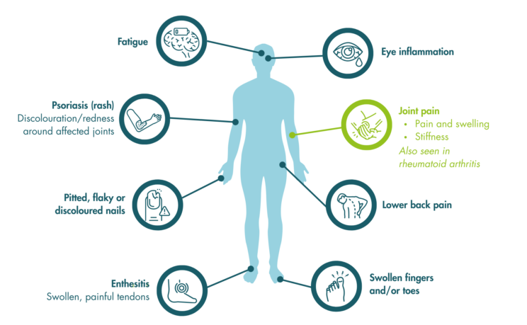 A body outline in the centre, with arrows identifying symptoms in specific areas of the body: fatigue, eye inflammation, psoriasis (rash), joint pain, pitted flaky or discoloured nails, lower back pain, swollen painful tendons (enthesitis) and swollen fingers and/or toes.