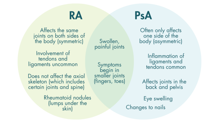 A venn diagram showing the symptoms of RA and PsA. At the centre, for both RA and PsA: “Swollen, painful joints”, and “Symptoms begin in smaller joints (fingers, toes)”. In the RA only section: “Affects the same joints on both sides of the body”, “Involvement of tendons and ligaments uncommon”, “Does not affect the axial skeleton”, and “Rheumatoid nodules (lumps under the skin)”. In the PsA only section, “Often only affects one side of the body”, “inflammation of ligaments and tendons common”, “Affects joints in the back and pelvis”, “Eye swelling” and “Changes to nails”.”