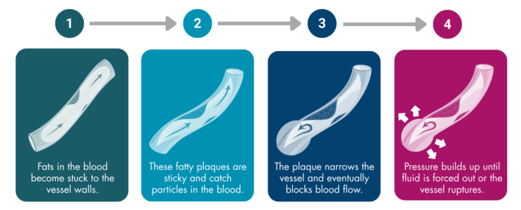 4 boxes labelled 1 to 4 with arrows between them and each with an image of a blood vessel with arrows showing the flow of blood. The image in the first box has a small lump on the inner wall, with the caption “fats in the blood become stuck to the vessel walls.”, the second has a bigger lump and the caption “these fatty plaques are sticky and catch particles in the blood.”, the third has the arrow with a reversed direction when it reaches the lump and a swelling in the blood vessel at this site, with the caption “the plaque narrows the vessel and eventually blocks blood flow.”, and the last is the same but with arrows pointing away from the blood vessel and the caption “pressure builds up until fluid is forced out or the vessel ruptures.”.