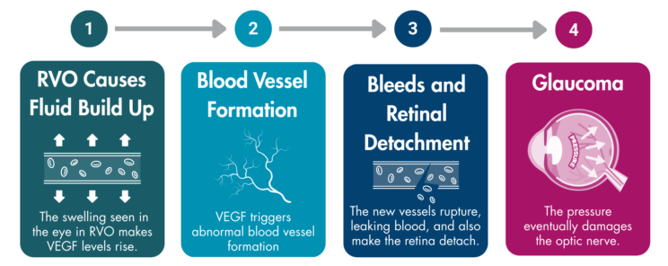 4 boxes labelled 1 to 4 with arrows between them. The first box has an image of a blood vessel with arrows pointing away from it and the caption “RVO causes fluid build up: The swelling seen in the eye in RVO makes VEGF levels rise.”. The second box has blood vessels branching and the caption “Blood vessel formation: VEGF triggers abnormal blood vessel formation.”. The third box has a broken blood vessel and the caption “Bleeds and retinal detachment: the new vessels rupture, leaking blood, and also make the retina detach.”. The last box has a cross section of an eye with pressure written inside and the text “Glaucoma: the pressure eventually damages the optic nerve.”.