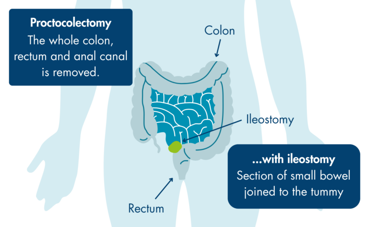A schematic diagram of a proctocolectomy which is when the whole colon, rectum and anal canal is removed with ileostomy which is when section of the small bowel is joined to the tummy.