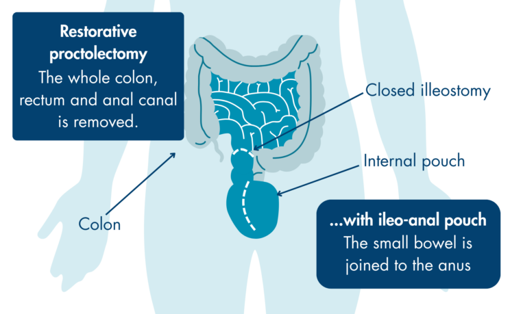 A schematic diagram of a restorative proctocolectomy which is when the whole colon, rectum and anal canal is removed with an ileo-anal pouch which is when the small bowel is joined to the anus.