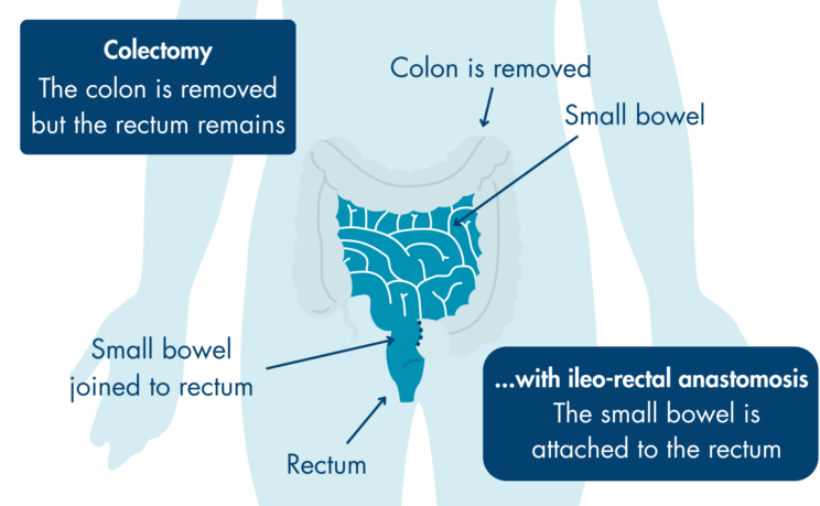 A schematic diagram of a colectomy which is when the colon is removed but the rectum remains with an ileo-rectal anastomosis which is when the small bowel is attached to the rectum.