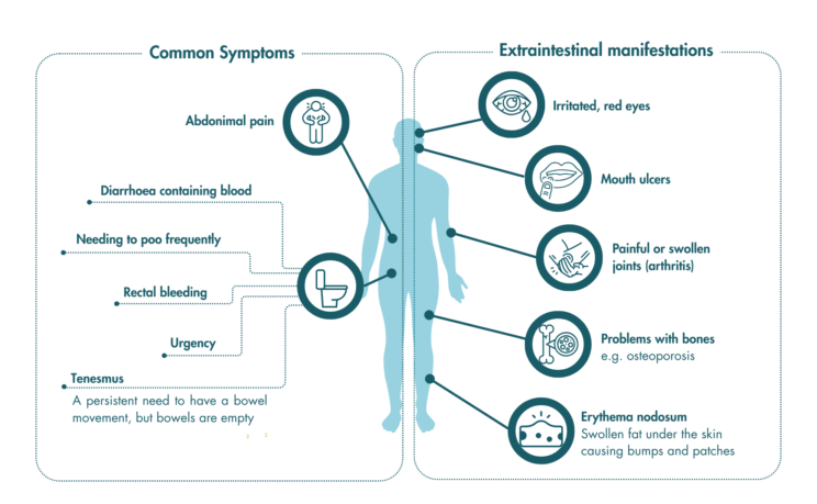 An outline of the human body highlighting the common symptoms and extraintestinal manifestations of UC. Common symptoms are: a abdominal pain, diarrhoea containing blood, needing to poo frequently, rectal bleeding, urgency and tenesmus (a persistent need to have a bowel movement, but bowels are empty). Extraintestinal manifestations are: irritated, red eyes, mouth ulcers, painful or swollen joints (arthritis), problems with bones e.g. osteoporosis and erthyema nodosum (swollen fat under the skin causing bumbs and patches).