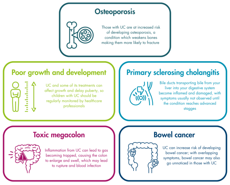 Boxes with text on five complications, which are 1. Osteoporosis - Those with UC are at increased risk of developing osteoporosis, a condition which weakens bones making them more likely to fracture. 2. Poor growth and development - UC and some of its treatments can affect growth and delay puberty, so children with UC should be regularly monitored by healthcare professionals. 3. Primary sclerosing cholangitis - Bile ducts transporting bile from your liver into your digestive system become inflamed and damaged, with symptoms usually not observed until the condition reaches advanced stages. 4. Toxic megacolon - Inflammation from UC can lead to gas becoming trapped, causing the colon to enlarge and swell, which may lead to rupture and blood infection. 5. Bowel cancer - UC can increase risk of developing bowel cancer; with overlapping symptoms, bowel cancer may also go unnoticed in those with UC.