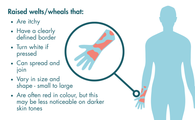 A graphic of a person outline with red patches of skin to signify raised welts/wheals. The text says “Raised welts/wheals that: are itchy, have a clearly defined border, turn white if pressed, can spread and join, vary in size and shape (small to large), and are often red in colour, but this may be less noticeable on darker skin tones.