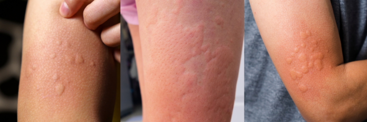 3 photos of the typical urticaria rash on skin.