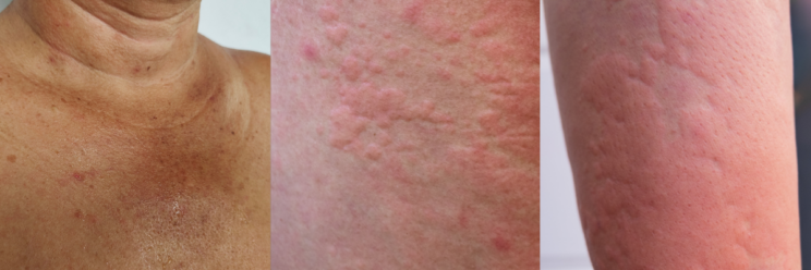 3 photographs of a urticaria rash on different skin types