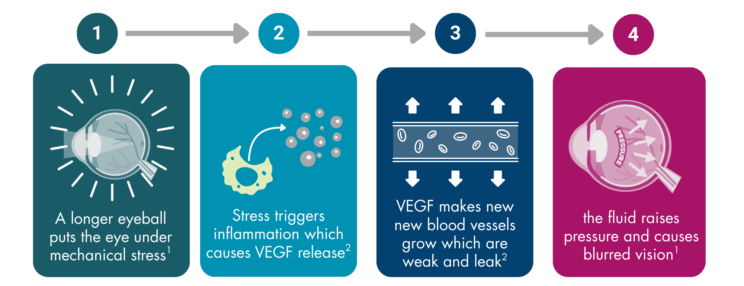 4 boxes labelled 1 to 4 with arrows between them. The first box contains an image of an eye with light entering and drawing to a point before the back of the eye and the text “a longer eyeball puts the eye under mechanical stress (reference 1)”. The second box shows a blood cell secreting chemicals and the text “Stress triggers inflammation which causes VEGF release (reference 2)”. The third box has arrows leaving the blood vessel and the text “VEGF makes blood vessels grow which are weak and leak (reference 2)”. The final box contains a cross section of an eye with pressure written inside and the text “the fluid raises pressure and causes blurred vision (reference 1)”.