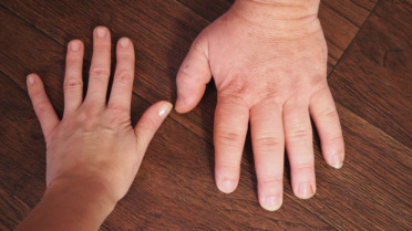 A photo of two people’s hands side by side. One of them has acromegaly, which has caused the hand to swell, and the other does not.
