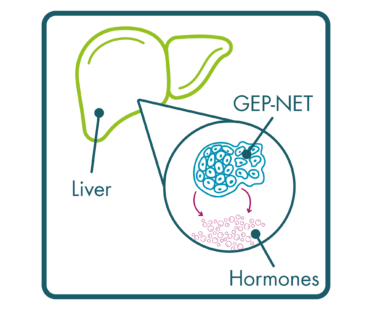 image of a liver with a zoomed-in section showing a GEP-NET releasing hormones.