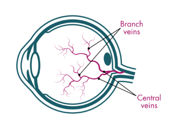 Line diagram of the cross-section of an eye. There are vessels in the centre space of the eye that start as thicker lines labelled central veins and branch off into thinner lines labelled branch veins.